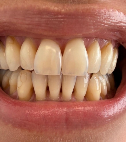 Antes e Depois – Dente 2 Antes e Depois - Dente 2